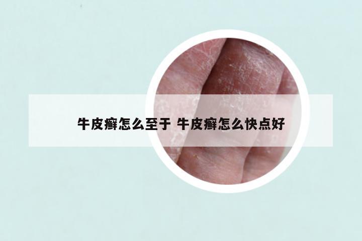 牛皮癣怎么至于 牛皮癣怎么快点好