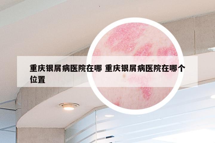重庆银屑病医院在哪 重庆银屑病医院在哪个位置
