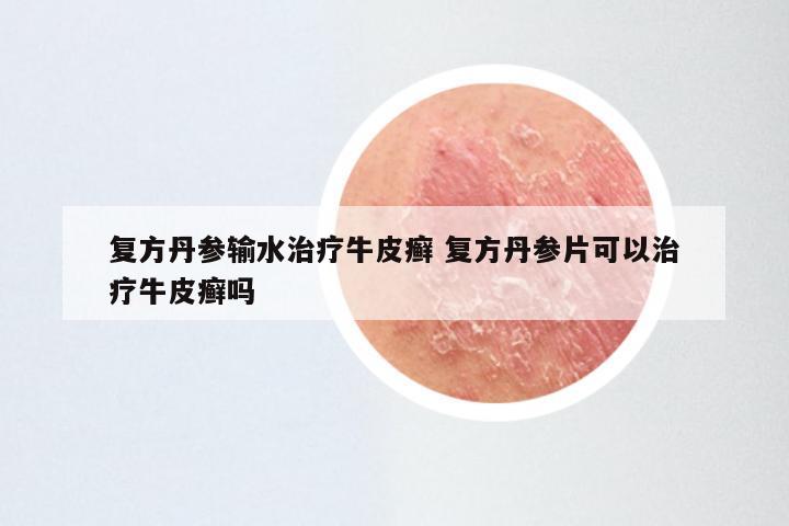 复方丹参输水治疗牛皮癣 复方丹参片可以治疗牛皮癣吗