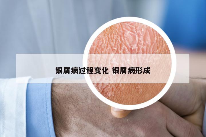 银屑病过程变化 银屑病形成