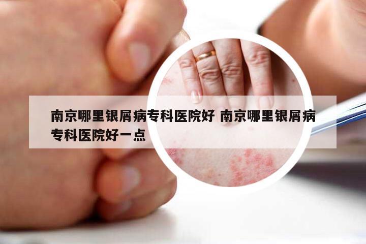 南京哪里银屑病专科医院好 南京哪里银屑病专科医院好一点
