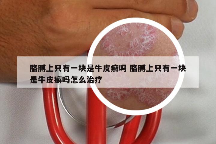 胳膊上只有一块是牛皮癣吗 胳膊上只有一块是牛皮癣吗怎么治疗