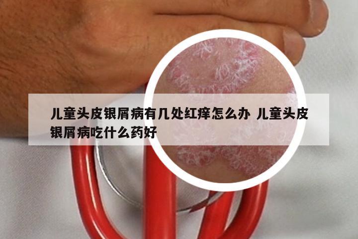 儿童头皮银屑病有几处红痒怎么办 儿童头皮银屑病吃什么药好