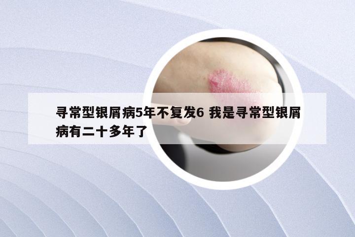 寻常型银屑病5年不复发6 我是寻常型银屑病有二十多年了