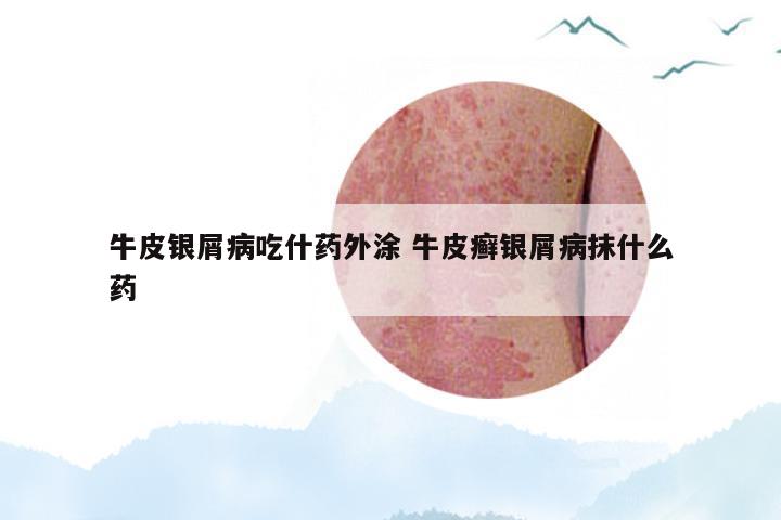 牛皮银屑病吃什药外涂 牛皮癣银屑病抹什么药