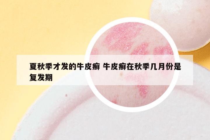 夏秋季才发的牛皮癣 牛皮癣在秋季几月份是复发期