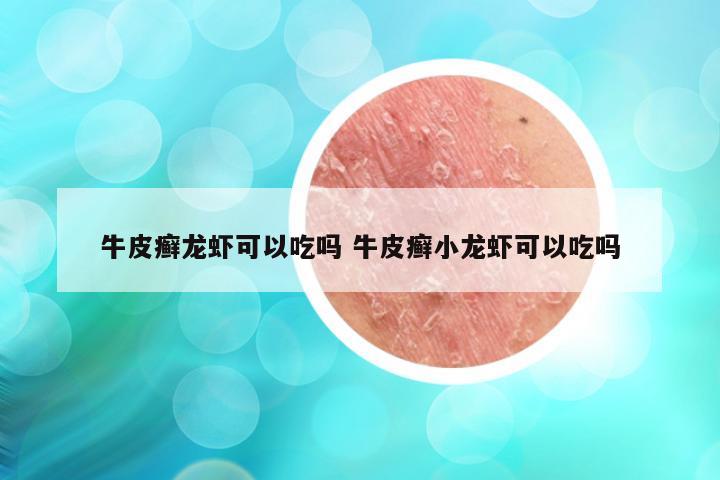 牛皮癣龙虾可以吃吗 牛皮癣小龙虾可以吃吗
