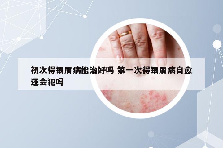 初次得银屑病能治好吗 第一次得银屑病自愈还会犯吗