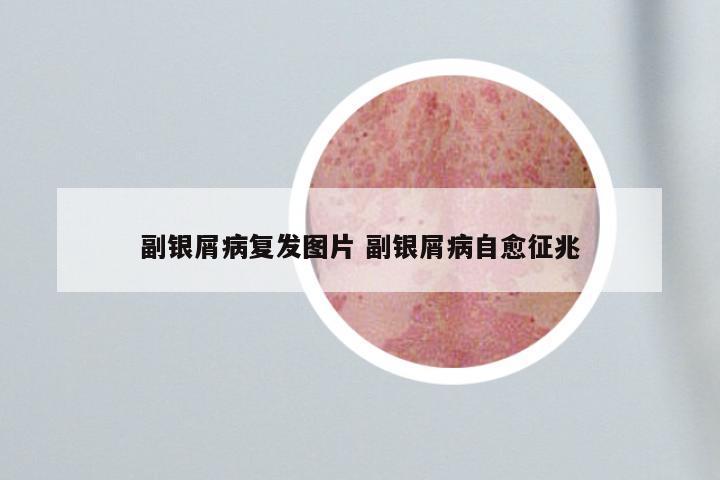副银屑病复发图片 副银屑病自愈征兆