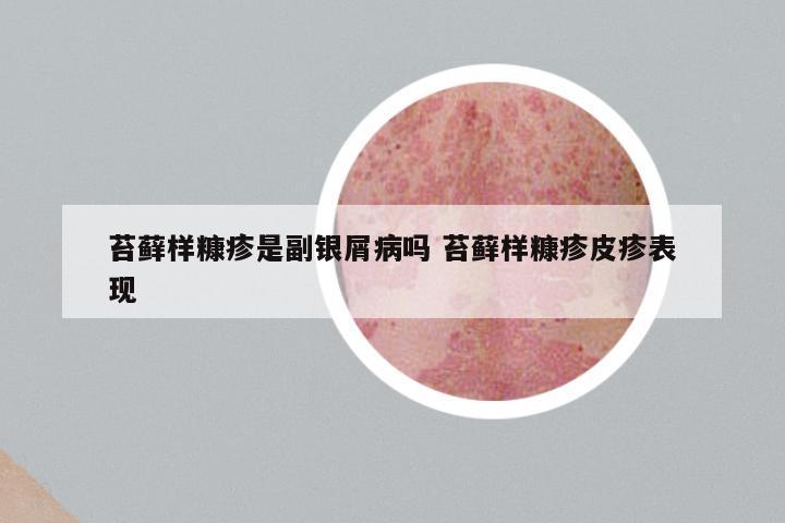 苔藓样糠疹是副银屑病吗 苔藓样糠疹皮疹表现