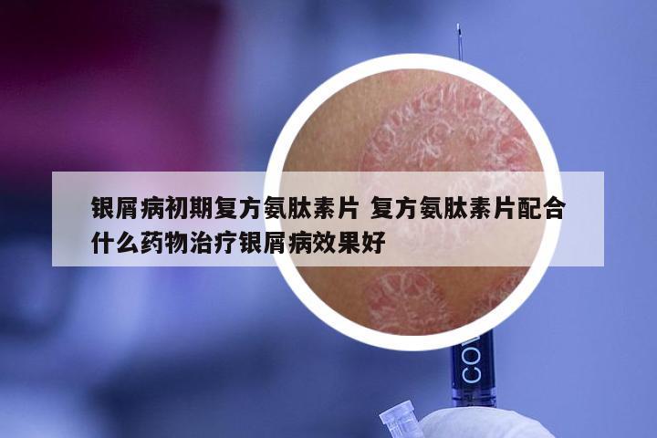 银屑病初期复方氨肽素片 复方氨肽素片配合什么药物治疗银屑病效果好