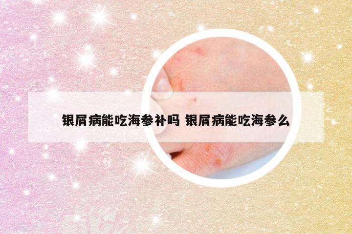 银屑病能吃海参补吗 银屑病能吃海参么