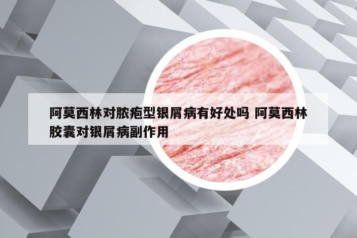 阿莫西林对脓疱型银屑病有好处吗 阿莫西林胶囊对银屑病副作用