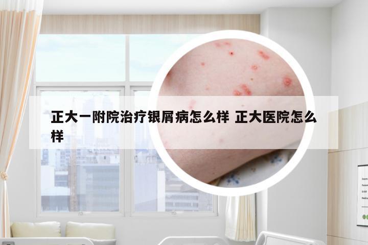 正大一附院治疗银屑病怎么样 正大医院怎么样