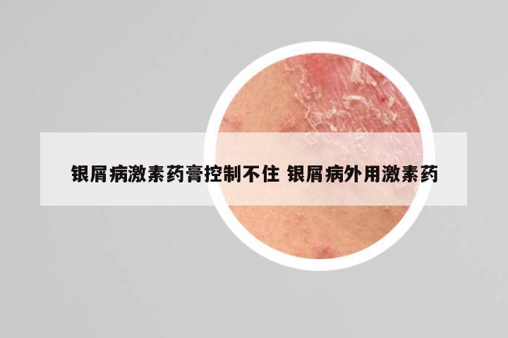 银屑病激素药膏控制不住 银屑病外用激素药
