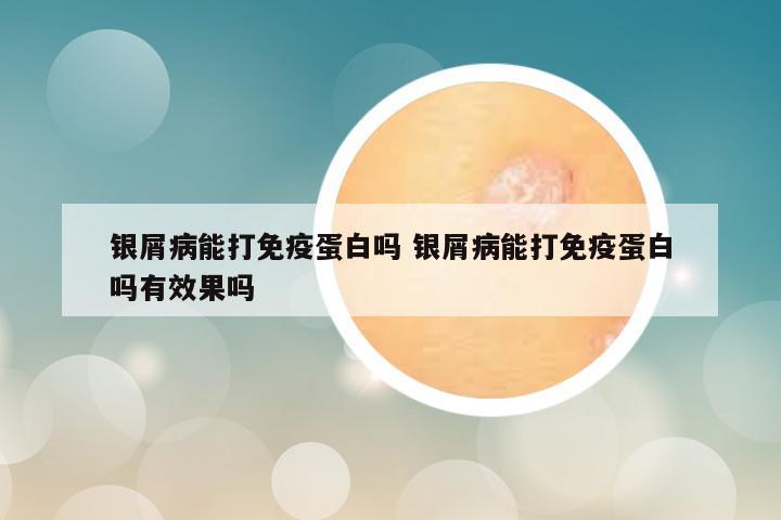 银屑病能打免疫蛋白吗 银屑病能打免疫蛋白吗有效果吗