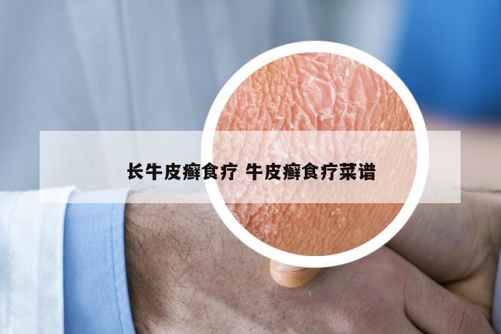 长牛皮癣食疗 牛皮癣食疗菜谱