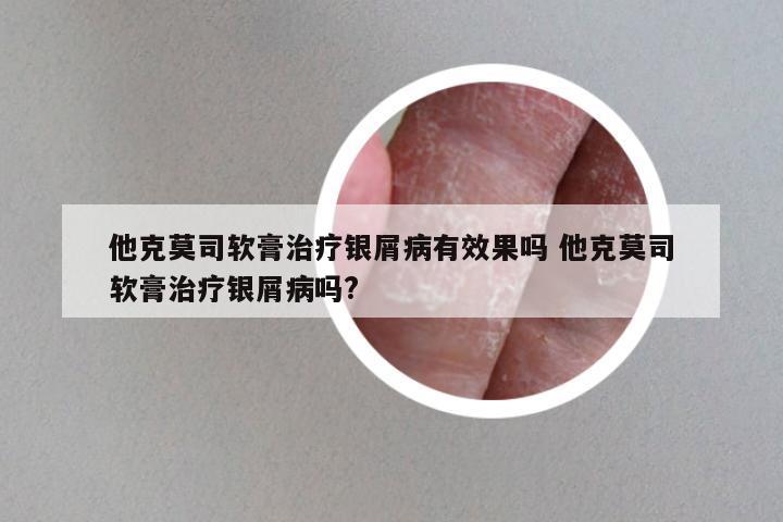他克莫司软膏治疗银屑病有效果吗 他克莫司软膏治疗银屑病吗?