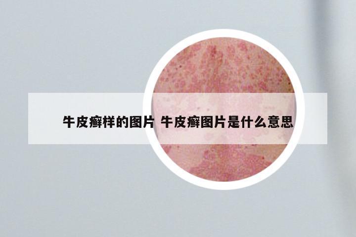 牛皮癣样的图片 牛皮癣图片是什么意思