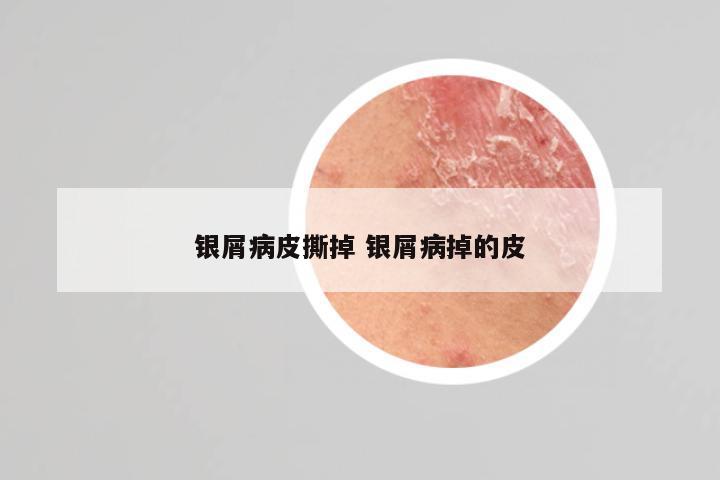 银屑病皮撕掉 银屑病掉的皮