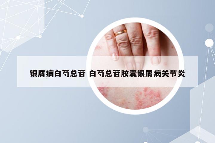 银屑病白芍总苷 白芍总苷胶囊银屑病关节炎