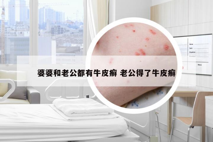 婆婆和老公都有牛皮癣 老公得了牛皮癣