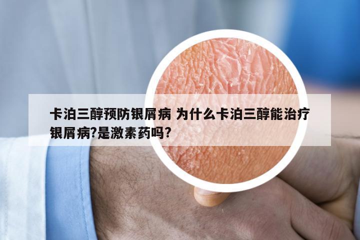 卡泊三醇预防银屑病 为什么卡泊三醇能治疗银屑病?是激素药吗?