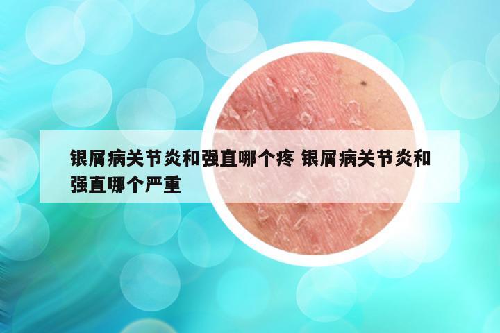 银屑病关节炎和强直哪个疼 银屑病关节炎和强直哪个严重