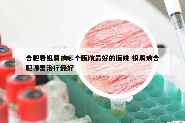 合肥看银屑病哪个医院最好的医院 银屑病合肥哪里治疗最好