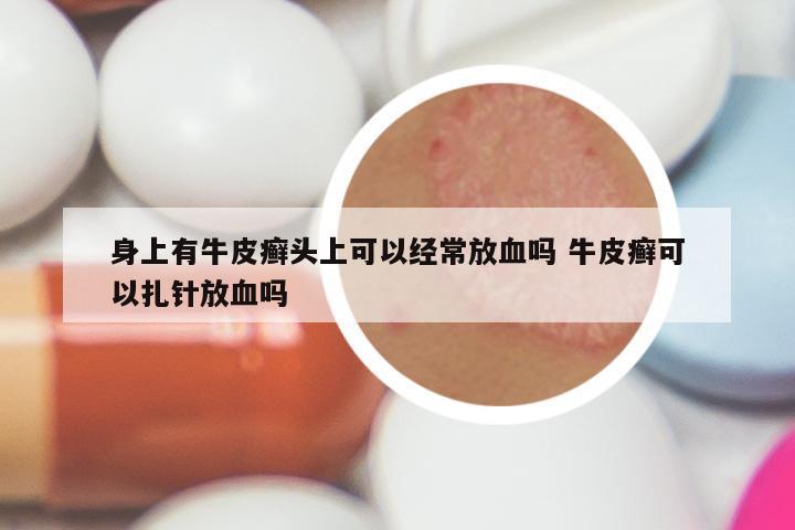 身上有牛皮癣头上可以经常放血吗 牛皮癣可以扎针放血吗