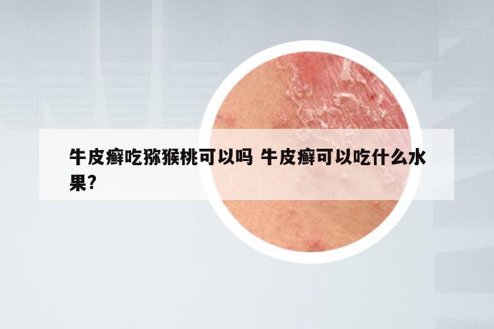 牛皮癣吃猕猴桃可以吗 牛皮癣可以吃什么水果?