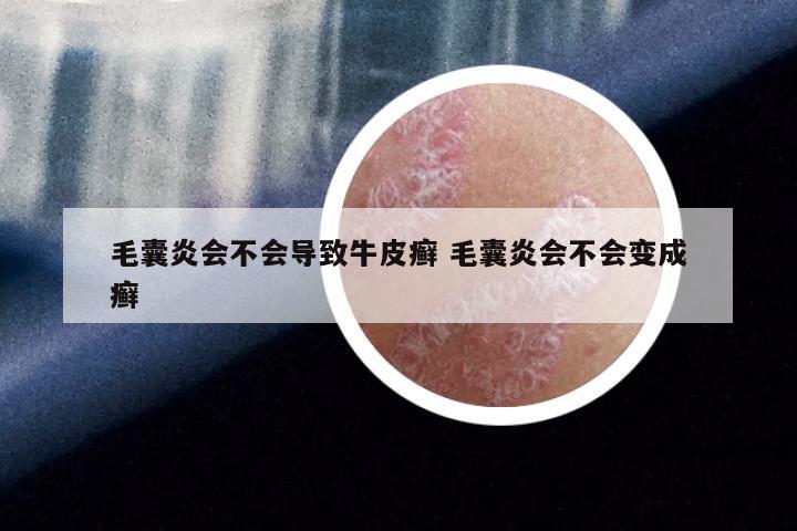 毛囊炎会不会导致牛皮癣 毛囊炎会不会变成癣