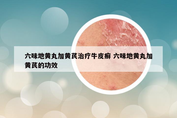 六味地黄丸加黄芪治疗牛皮癣 六味地黄丸加黄芪的功效
