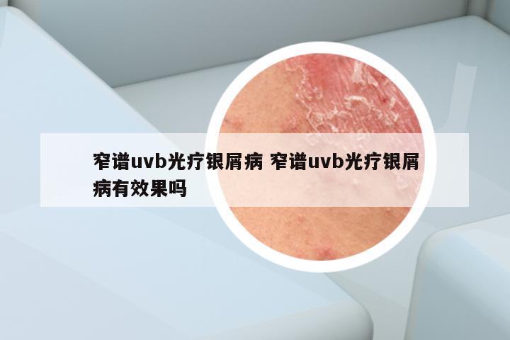 窄谱uvb光疗银屑病 窄谱uvb光疗银屑病有效果吗