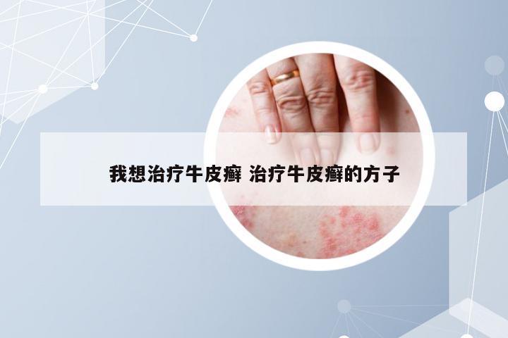 我想治疗牛皮癣 治疗牛皮癣的方子