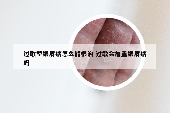 过敏型银屑病怎么能根治 过敏会加重银屑病吗