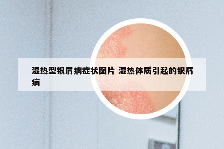 湿热型银屑病症状图片 湿热体质引起的银屑病