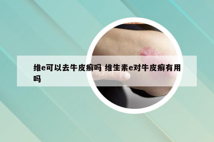 维e可以去牛皮癣吗 维生素e对牛皮癣有用吗