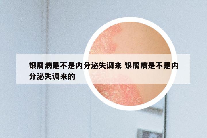 银屑病是不是内分泌失调来 银屑病是不是内分泌失调来的