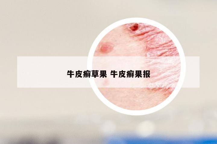 牛皮癣草果 牛皮癣果报
