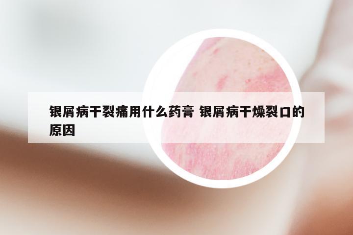 银屑病干裂痛用什么药膏 银屑病干燥裂口的原因