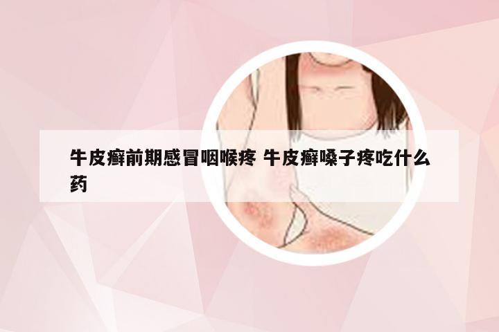 牛皮癣前期感冒咽喉疼 牛皮癣嗓子疼吃什么药