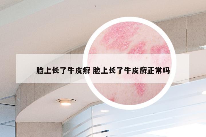 脸上长了牛皮癣 脸上长了牛皮癣正常吗