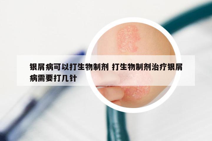 银屑病可以打生物制剂 打生物制剂治疗银屑病需要打几针