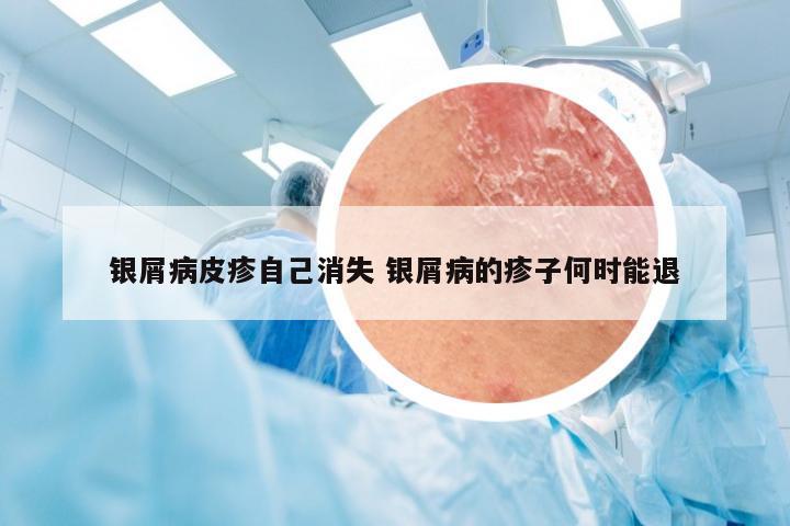 银屑病皮疹自己消失 银屑病的疹子何时能退