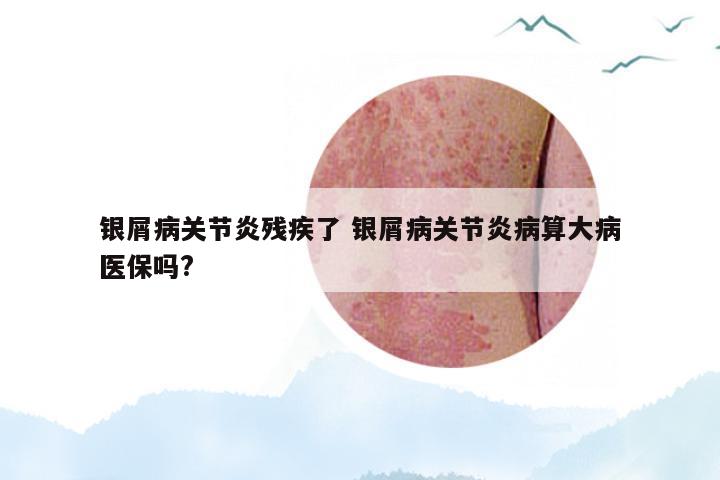 银屑病关节炎残疾了 银屑病关节炎病算大病医保吗?