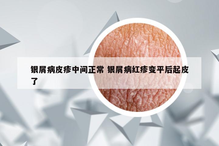 银屑病皮疹中间正常 银屑病红疹变平后起皮了