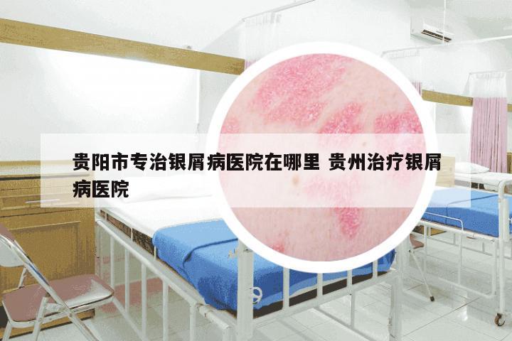 贵阳市专治银屑病医院在哪里 贵州治疗银屑病医院