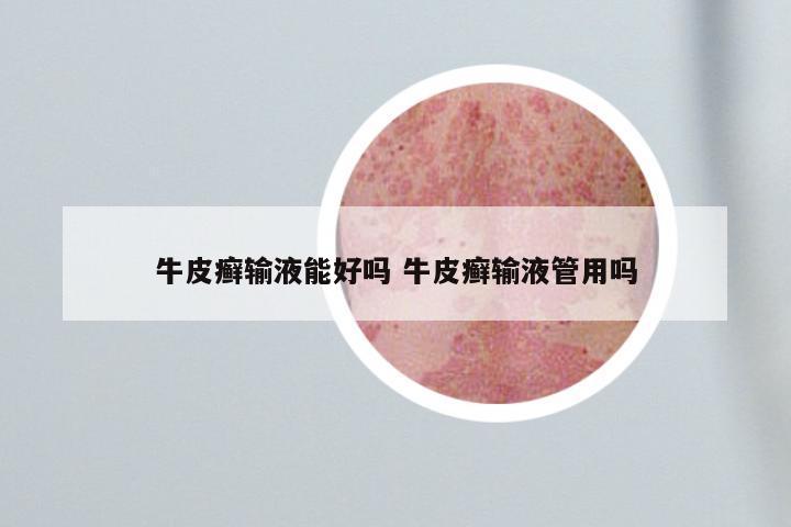 牛皮癣输液能好吗 牛皮癣输液管用吗