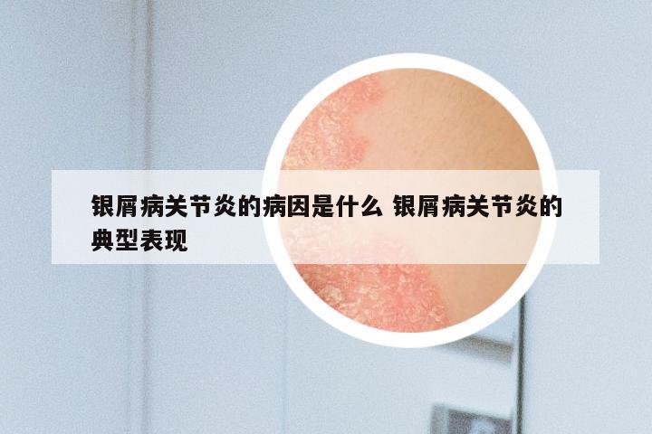 银屑病关节炎的病因是什么 银屑病关节炎的典型表现